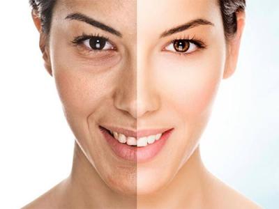 Hyperpigmentation Treatment NYC 1 