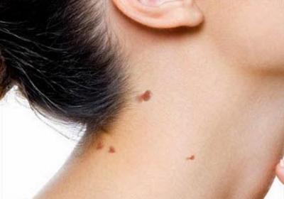 Skin Tag And Warts Removal 1 
